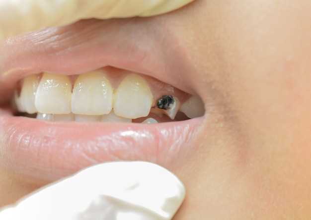 Зубной камень: причины, последствия и способы предотвращения