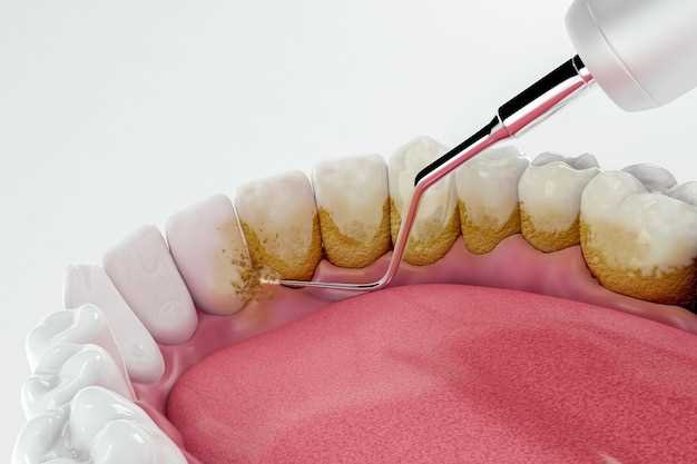 Осложнения при отсутствии профилактики зубного налета и камней