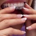 Виниры и накладки – как сохранить красоту зубов на долгие годы